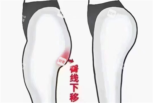 臀部脂肪填充对比.jpg