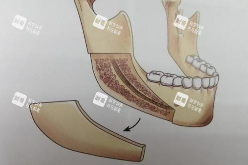 下颌角截骨卡通图.jpg 下颌角截骨卡通图.jpg