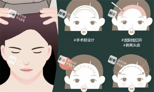 额头缩小手术过程.jpg