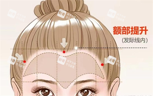 额部提升所定位切口的位置.jpg