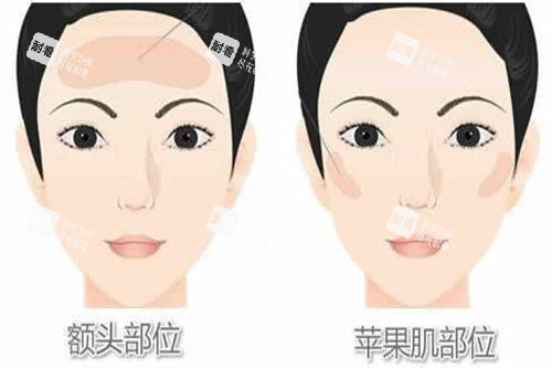 脂肪填充部位展示图.jpg