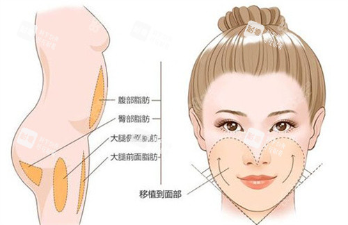 面部脂肪填充卡通图.jpg