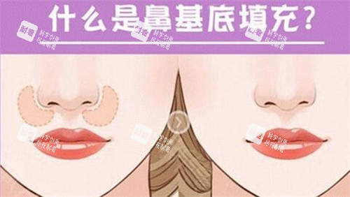 什么是鼻基底填充.jpg