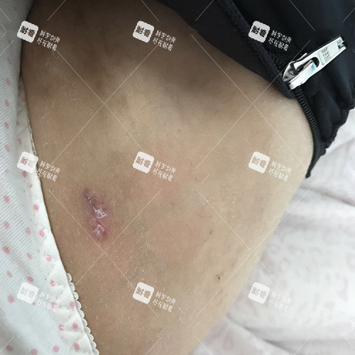 大腿吸脂伤口.jpg
