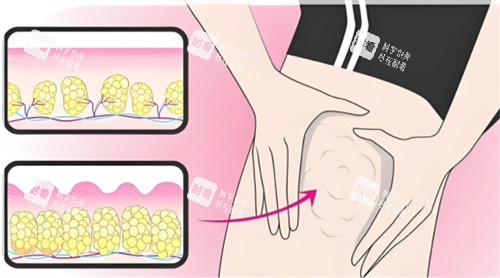 吸脂大腿部位.jpg