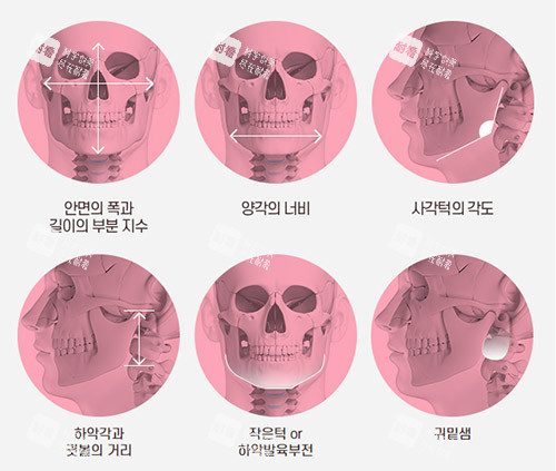 面部轮廓手术示意图.jpg