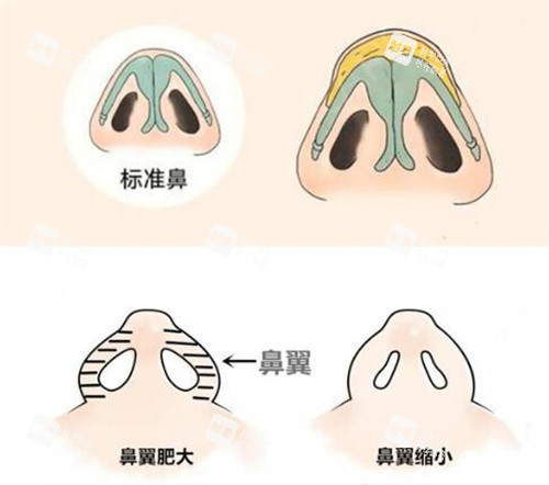 鼻翼缩小改善展示图.jpg 鼻翼缩小改善展示图.jpg