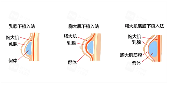 假体隆胸假体植入层次图.png