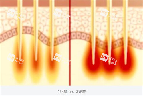 黑曜双波黄金微针双波发射模式.jpg