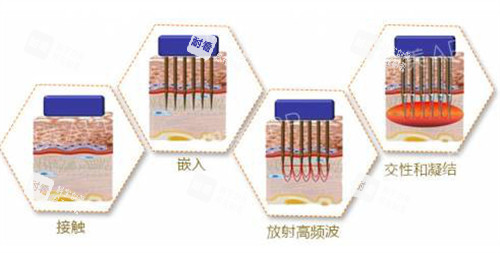 黄金微针原理解析.jpg