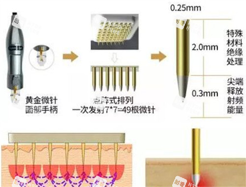 膨胀纹微针治疗过程.jpg