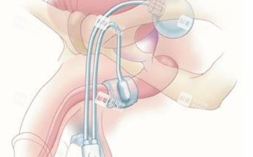 男性私密整形勃起治疗卡通示意图.jpg 男性私密整形勃起治疗卡通示意图.jpg