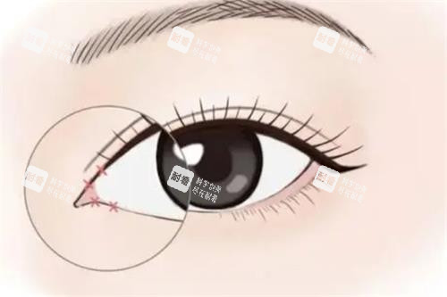 开眼角手术动画图示.png