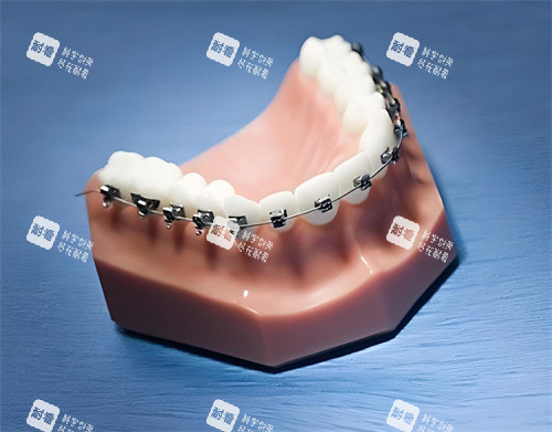 牙齿矫正模型展示图片.jpg 牙齿矫正模型展示图片.jpg