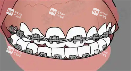 牙齿矫正动画图.jpg 牙齿矫正动画图.jpg