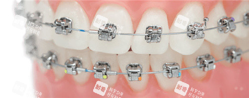 自锁托槽矫正器模型.jpg 自锁托槽矫正器模型.jpg