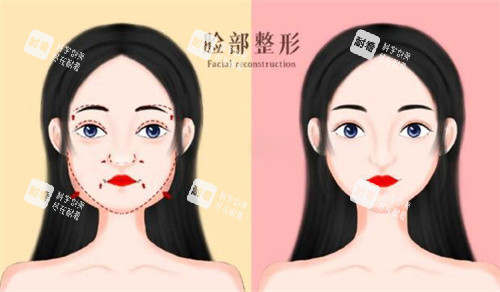 面部轮廓前后对比卡通图.jpg