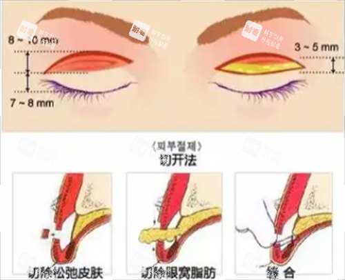 切开双眼皮手术.png