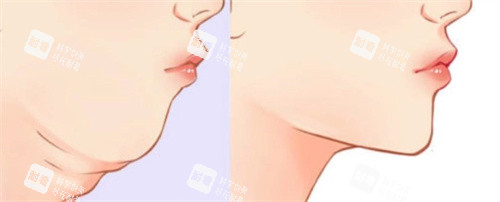 双下巴吸脂前后.jpg
