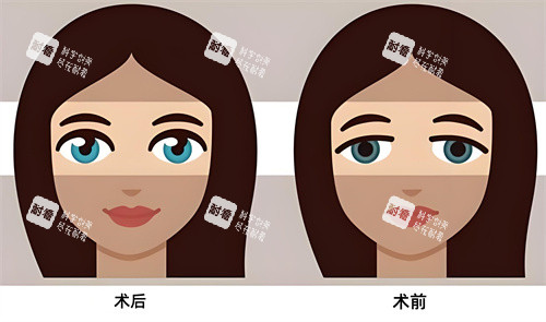 双眼皮术后术前对比动画图.jpg