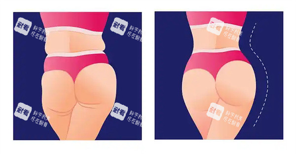 臀部脂肪填充.jpg
