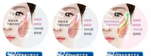 三类拉皮手术方法对比.jpg 三类拉皮手术方法对比.jpg