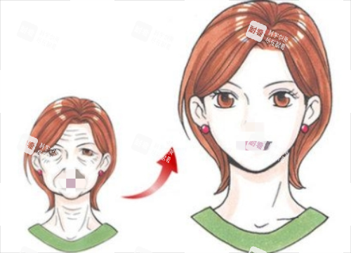 拉皮手术前后对比图.png 拉皮手术前后对比图.png