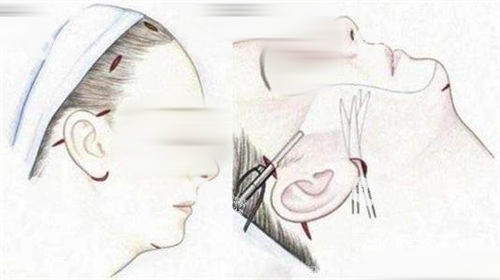 拉皮手术画线手术过程展示图.jpg.jpg 拉皮手术画线手术过程展示图.jpg.jpg