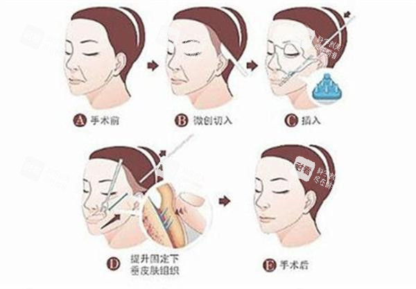拉皮手术全过程.jpg 拉皮手术全过程.jpg