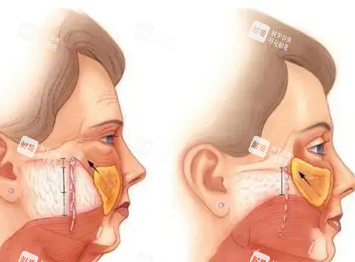 面部筋膜层拉皮提升卡通示意图.jpg 面部筋膜层拉皮提升卡通示意图.jpg