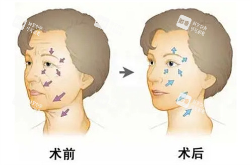 面部年轻化管理前后对比.jpg