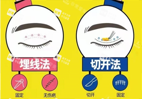 双眼皮埋线和切开对比图.png