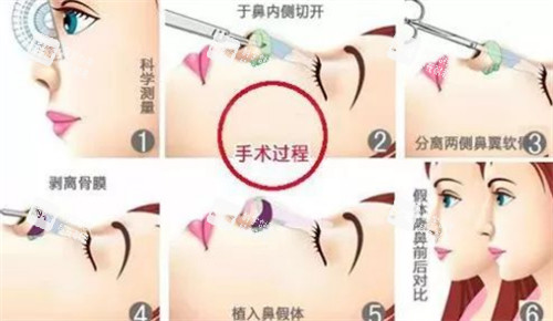 隆鼻过程图解.jpg