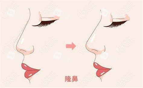 隆鼻术图.jpg