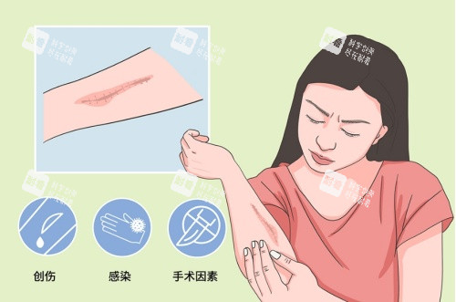 疤痕增生引起的因素示意图.jpg 疤痕增生引起的因素示意图.jpg