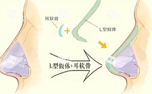 L形隆鼻假体.jpg