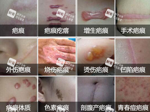 常见的疤痕类型展示图.jpg 常见的疤痕类型展示图.jpg