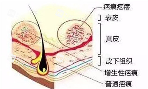 疤痕疙瘩皮肤解析图.jpg 疤痕疙瘩皮肤解析图.jpg