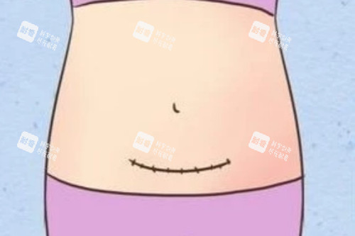 剖腹产疤痕图.jpg 剖腹产疤痕图.jpg