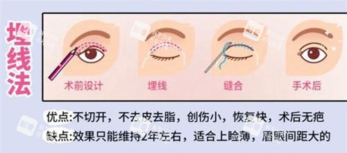 双眼皮手术埋线法动画演示图.jpg 双眼皮手术埋线法动画演示图.jpg