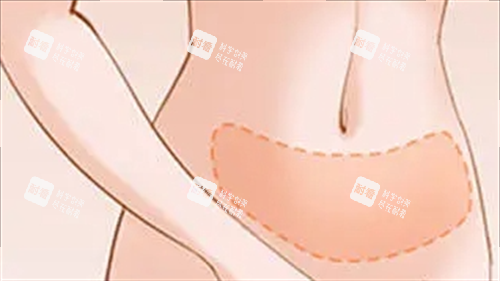 腹部吸脂成效展示图.png 腹部吸脂成效展示图.png