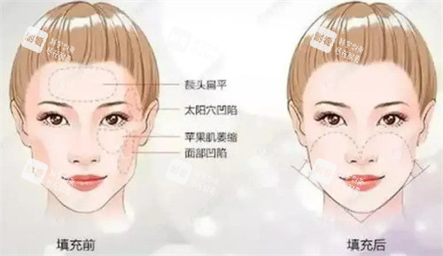 面颊填充术前后对比.jpg 面颊填充术前后对比.jpg