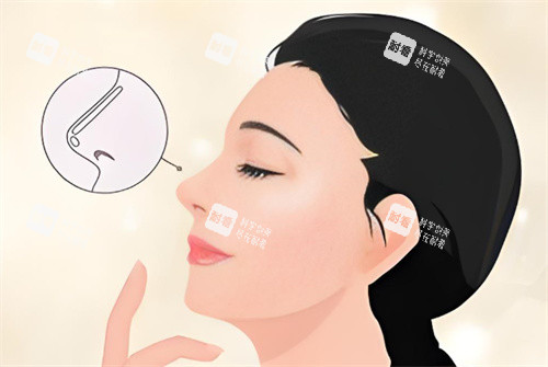 假体隆鼻卡通图.jpg 假体隆鼻卡通图.jpg