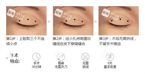 双眼皮三点术过程特点.jpg