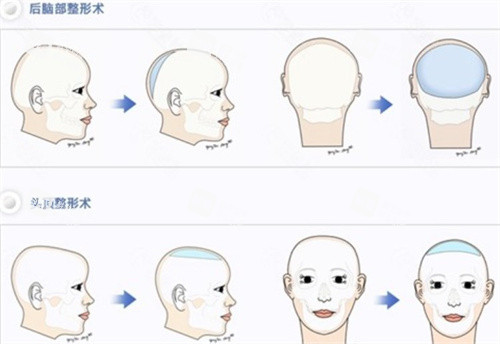 后脑勺整形.jpg 后脑勺整形.jpg