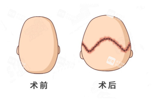 后脑勺整形卡通对比图.jpg 后脑勺整形卡通对比图.jpg