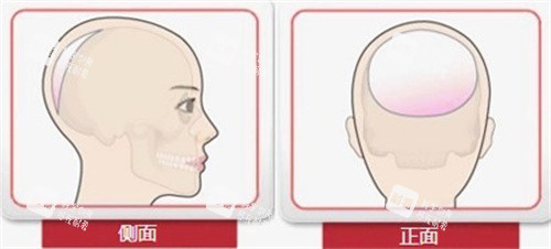 后脑勺整形手术.jpg 后脑勺整形手术.jpg