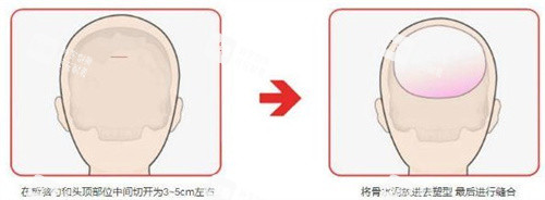 后脑勺整形手术图.jpg 后脑勺整形手术图.jpg