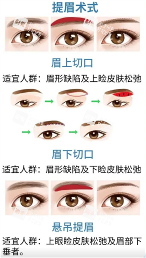 提眉术式解析.jpg 提眉术式解析.jpg