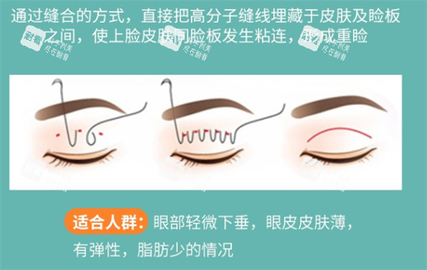 埋线双眼皮解析.jpg
